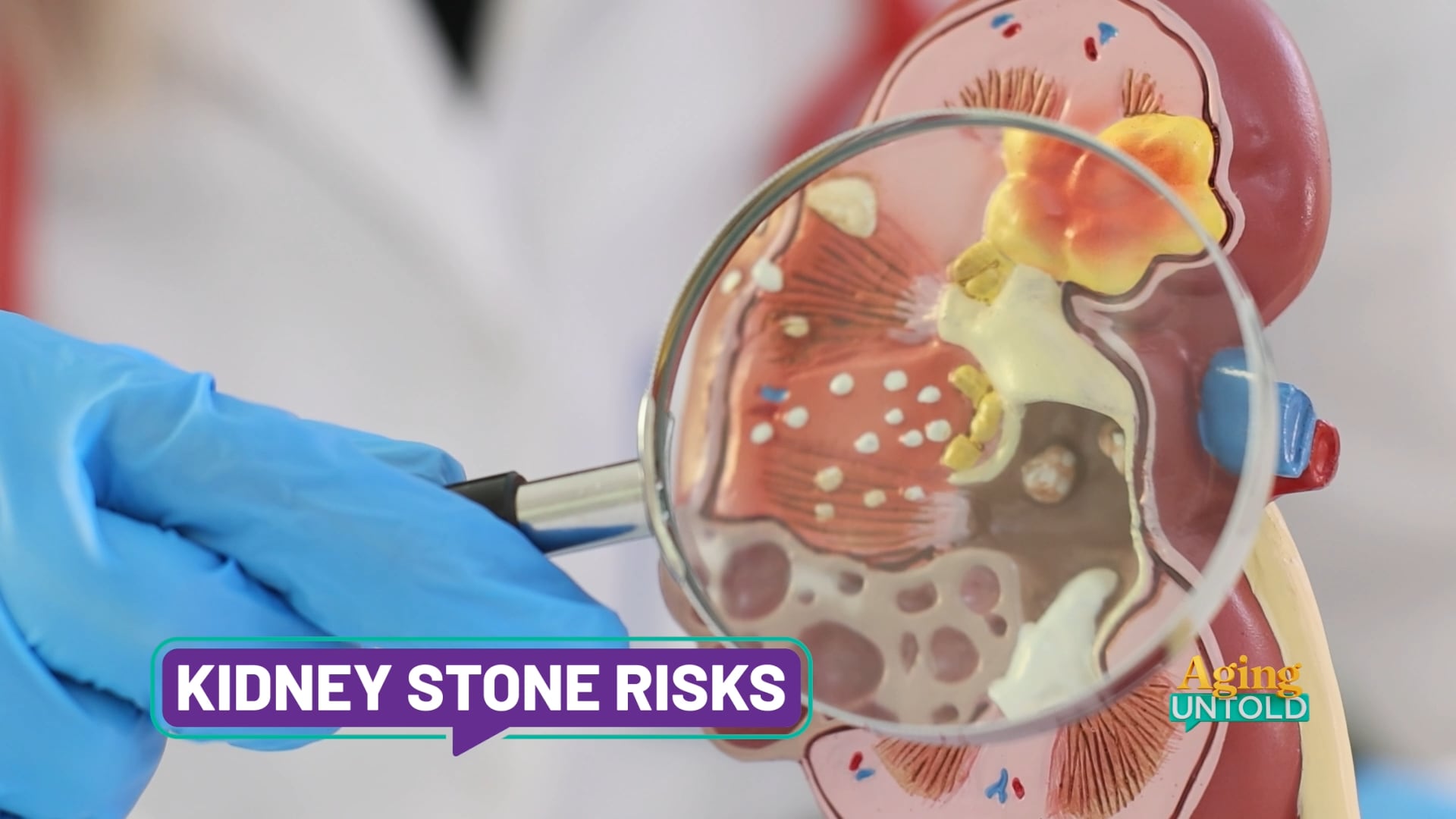 Kidney Stones Spark Concern Over Intense Pain in Lafayette, IN